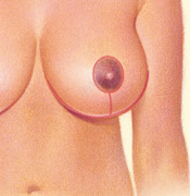 mama hipertrofica reduccion mamaria 2