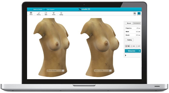dr martin ulloa cirujano plastico software visualizacion 3D aumento de pechos modelado realista